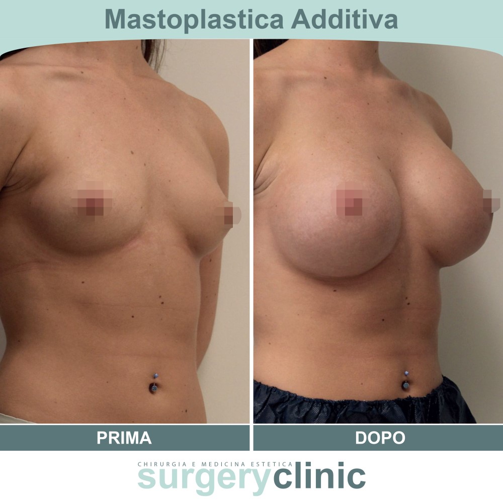Mastoplastica prima e dopo