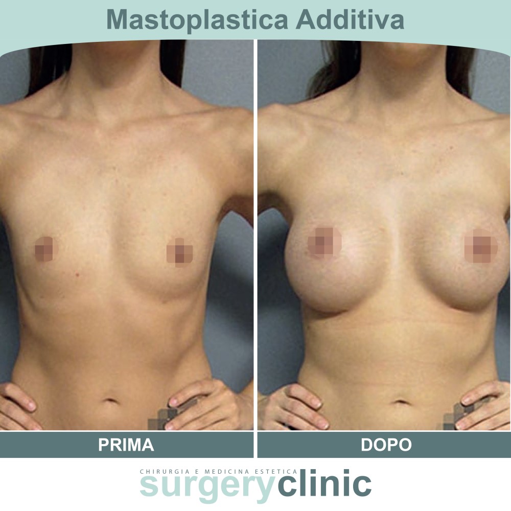 Mastoplastica prima e dopo