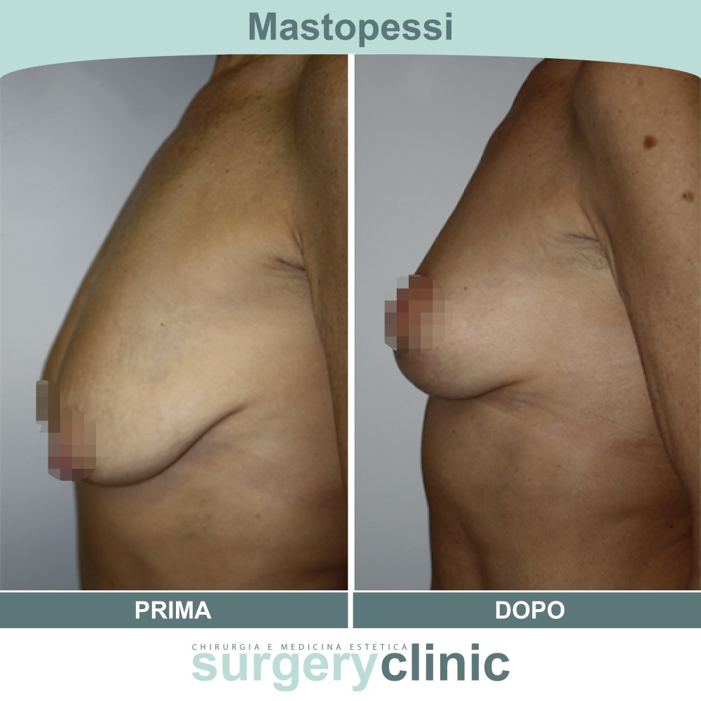 Mastopessi prima e dopo