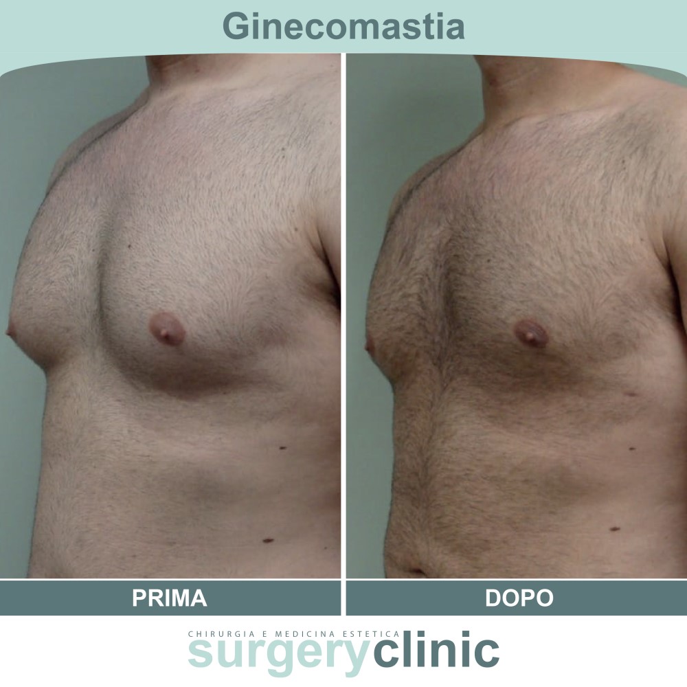 Ginecomastia prima e dopo