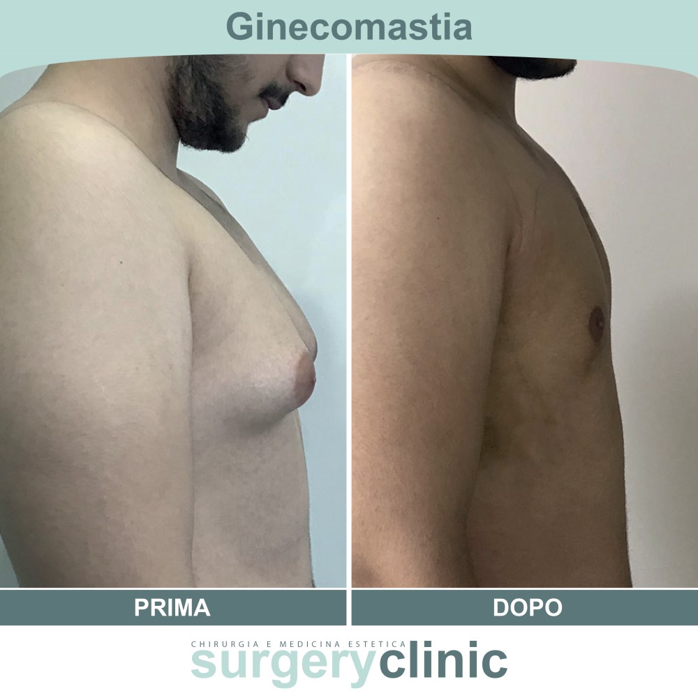 Ginecomastia prima e dopo