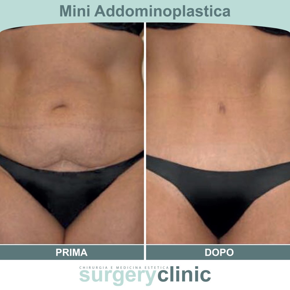 Mini addominoplastica prima e dopo