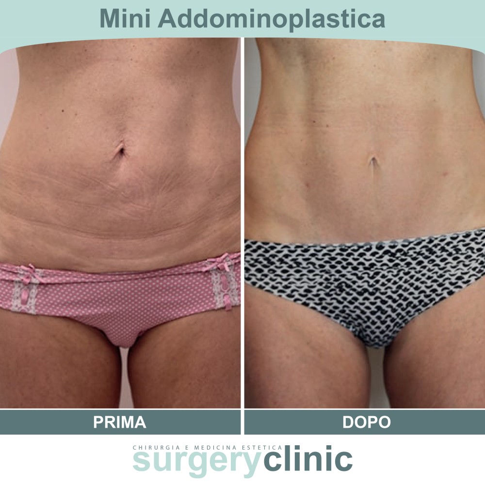 Mini addominoplastica prima e dopo