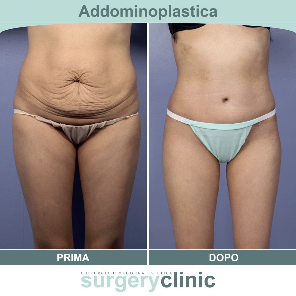 Addominoplastica prima e dopo
