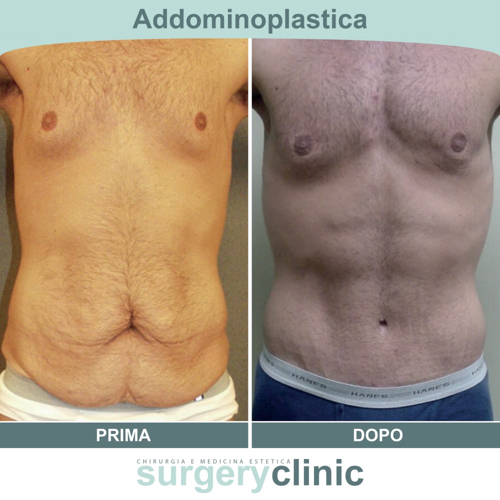 Addominoplastica prima e dopo