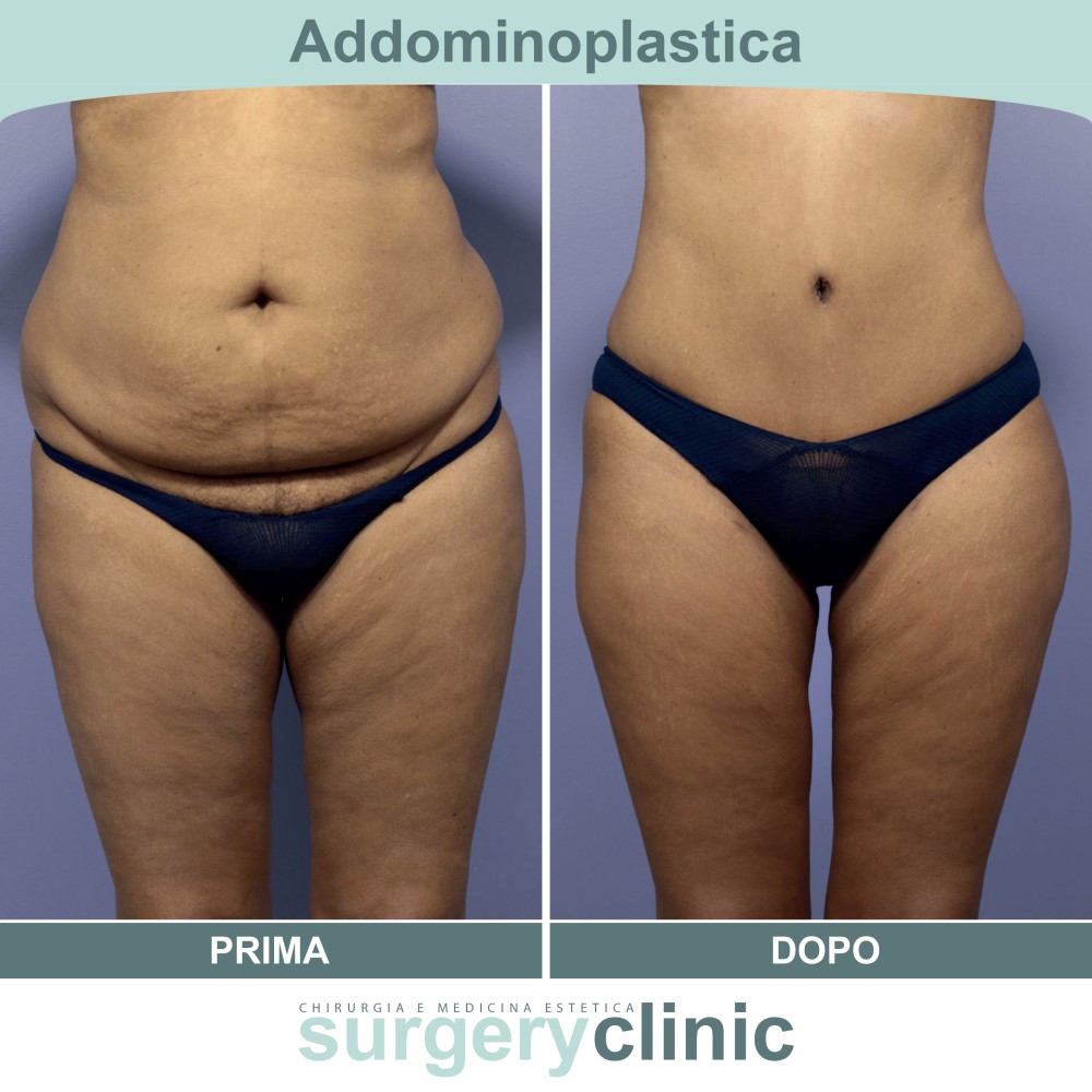 Addominoplastica prima e dopo