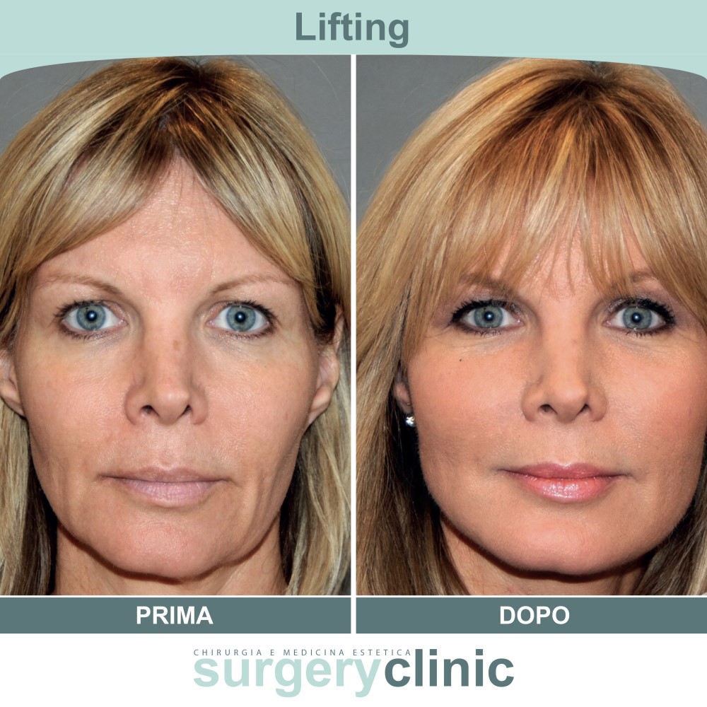 Lifting prima e dopo