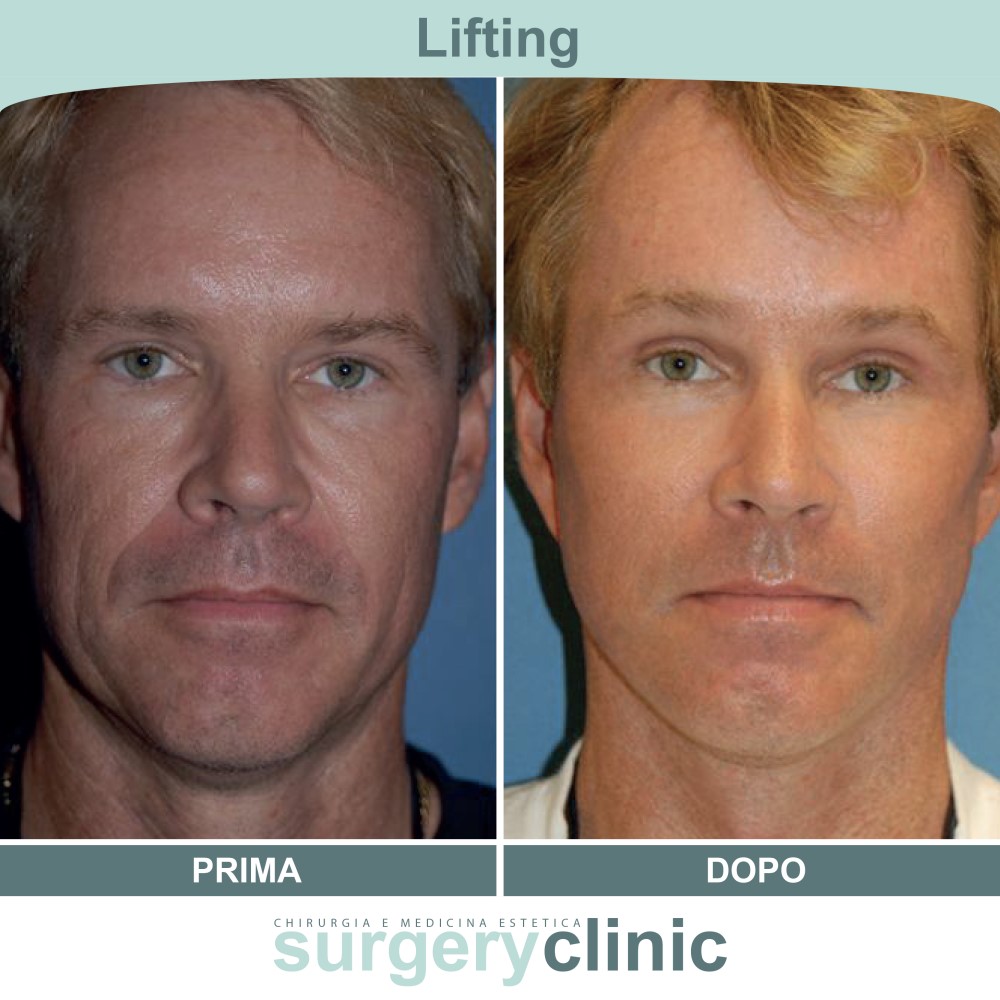 Lifting prima e dopo