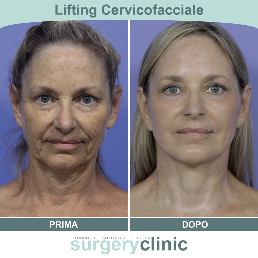 Lifting prima e dopo