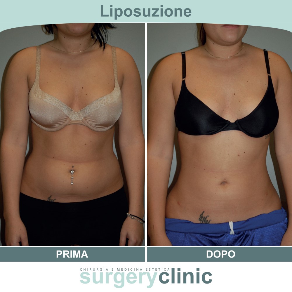 Liposuzione prima e dopo