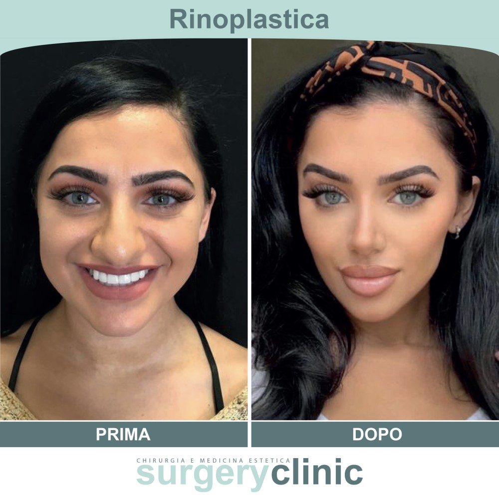 Rinosettoplastica prima e dopo