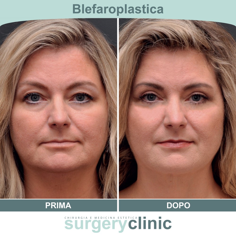 Blefaroplastica prima e dopo