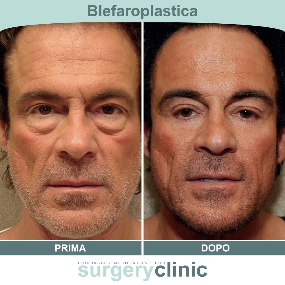 Blefaroplastica prima e dopo
