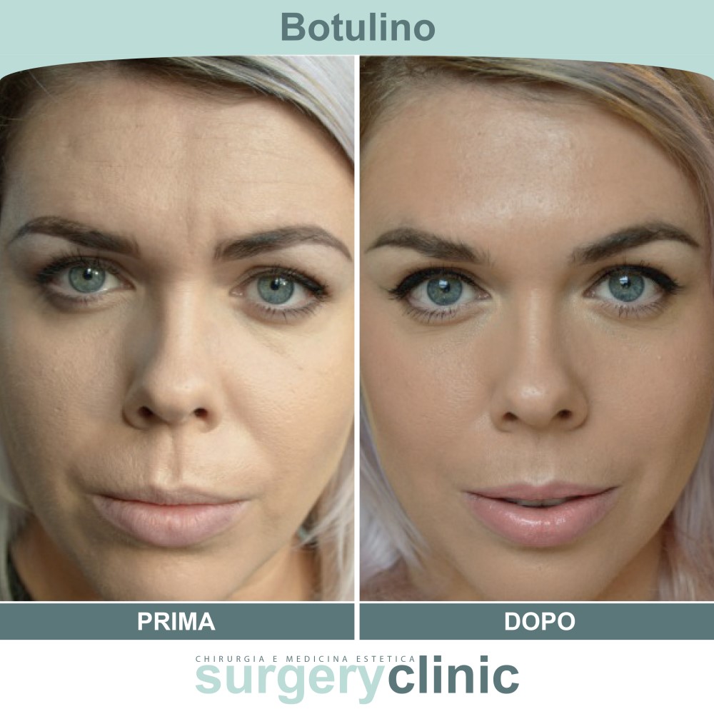 Botulino prima e dopo