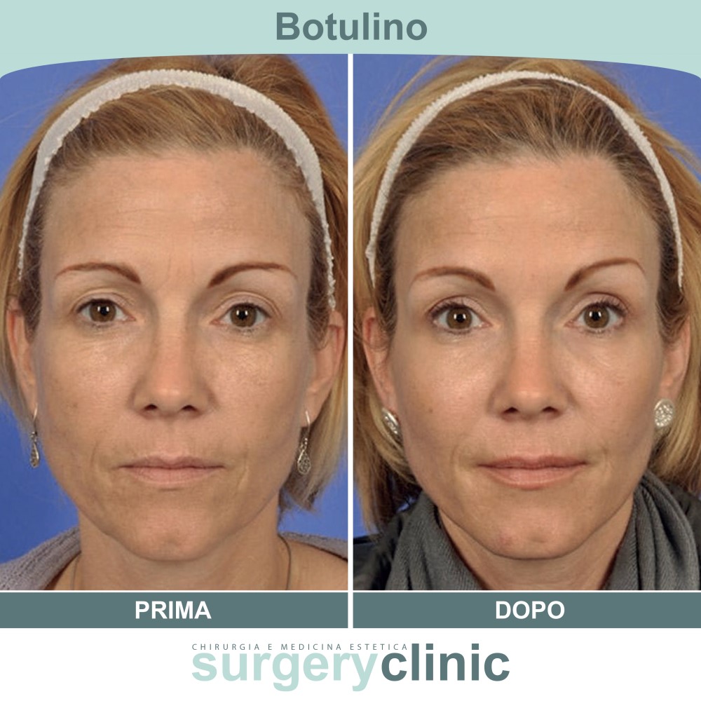 Botulino prima e dopo