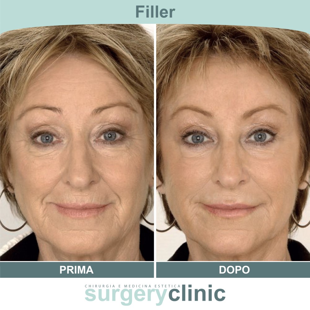 Filler prima e dopo