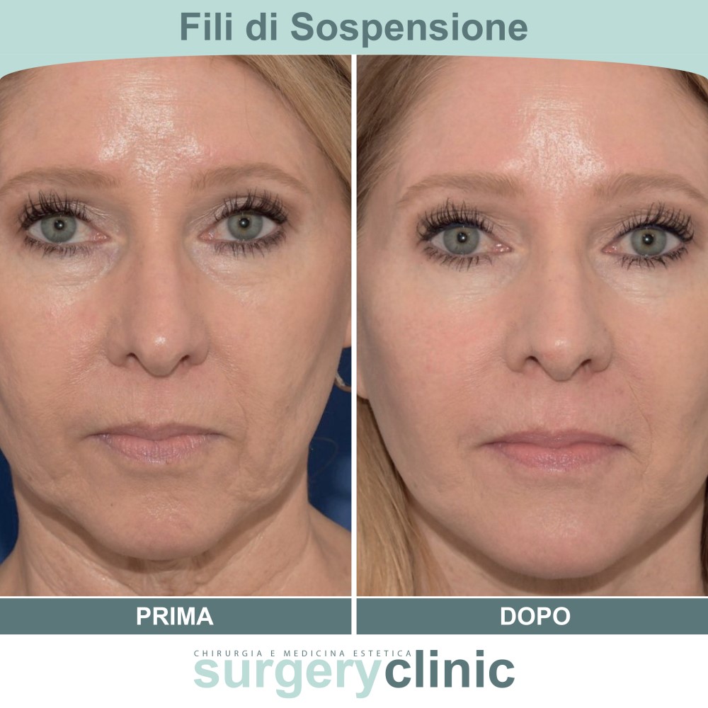 Fili di sospensione prima e dopo