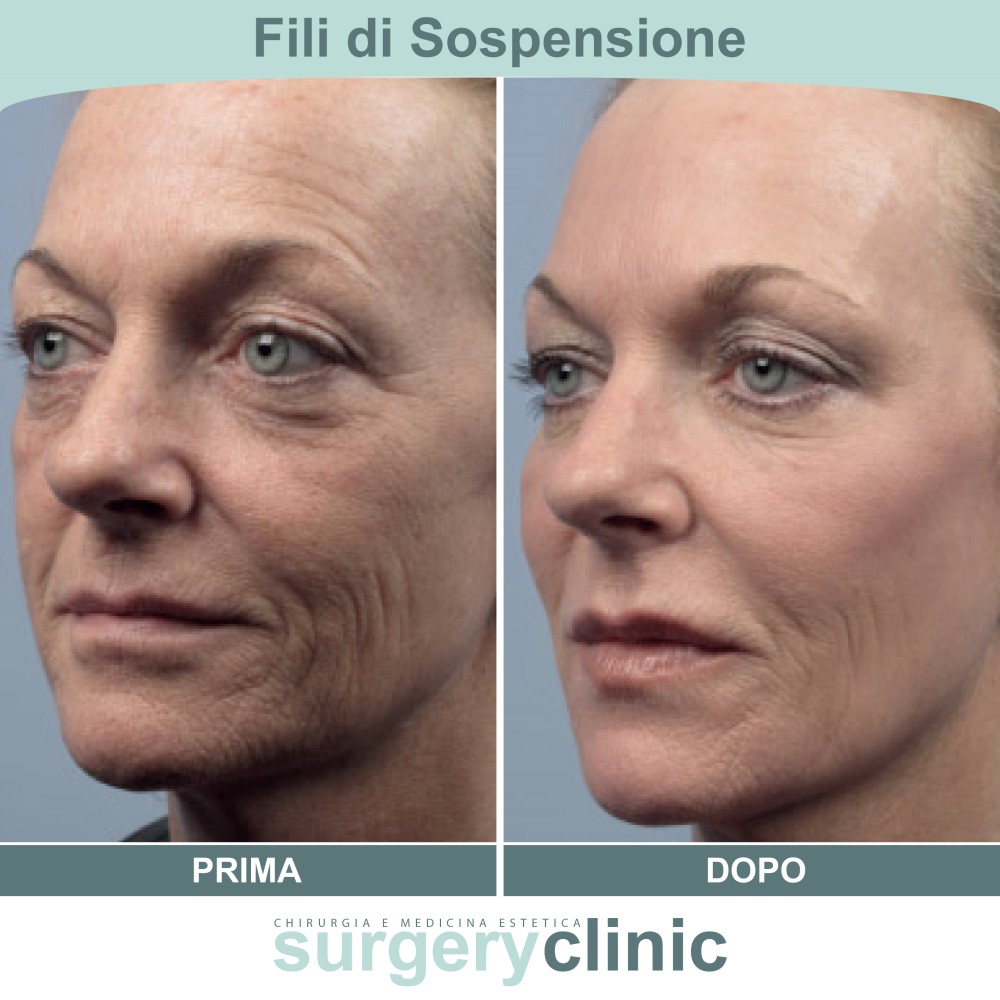 Fili di sospensione prima e dopo