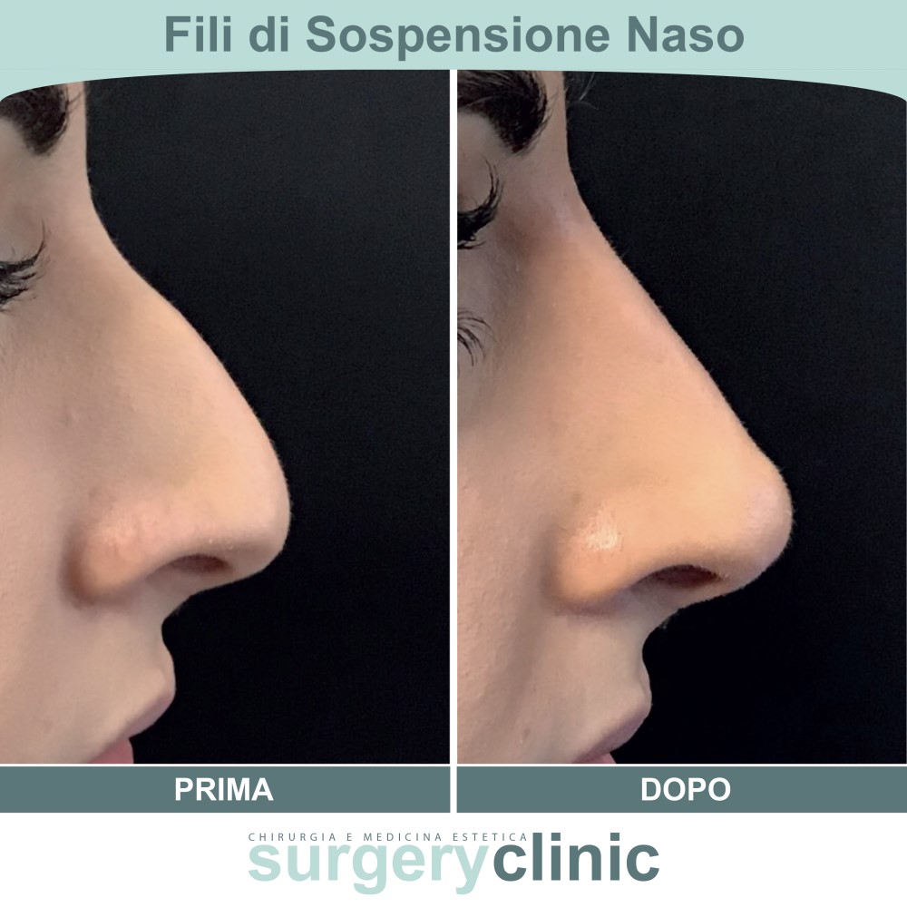 Fili di sospensione prima e dopo