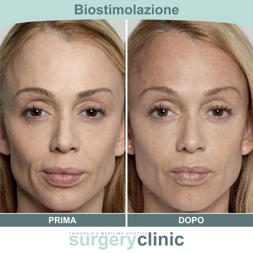Biostimolazione prima e dopo