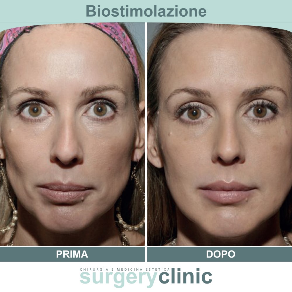 Biostimolazione prima e dopo