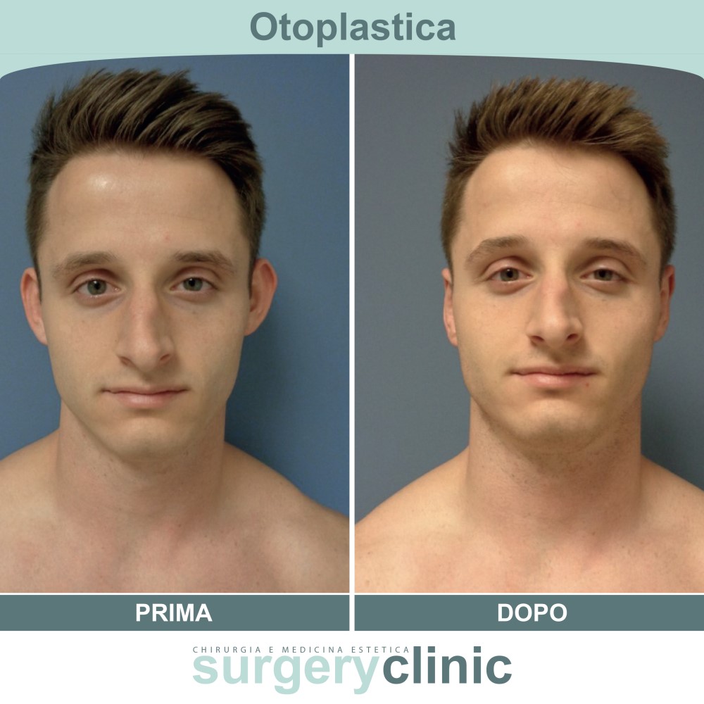 Otoplastica prima e dopo