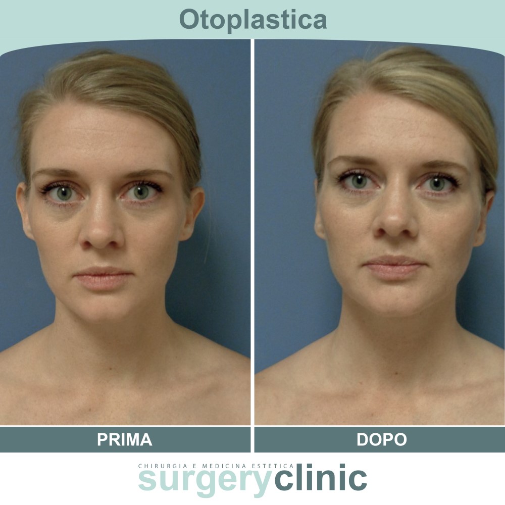 Otoplastica prima e dopo