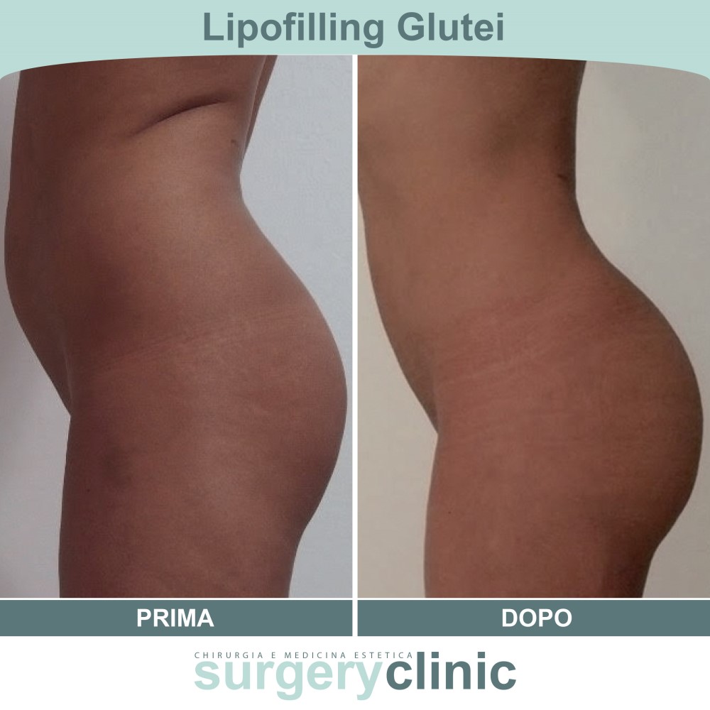 Lipofilling glutei prima e dopo